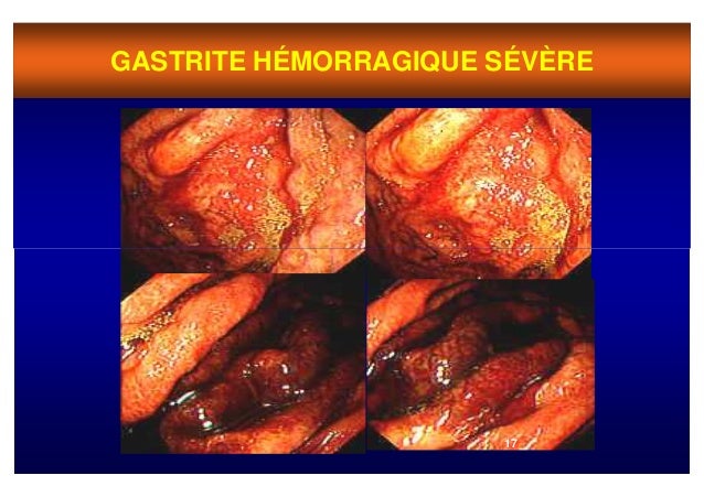 gastrite hemorragica